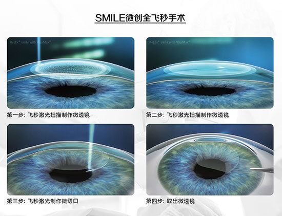 蔡司全飛秒、蔡司半飛秒近視手術(shù)與宇航飛秒的區(qū)別